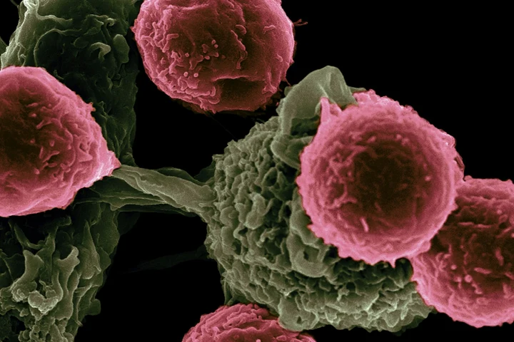 Din ce cauză tot mai mulți tineri se îmbolnăvesc de cancer de colon. Mâncarea care îi îmbolnăvește pe tineri