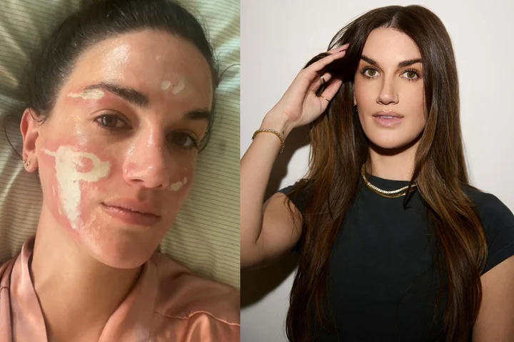 O tânără a fost desfigurată după un tratament cosmetic de zeci de mii de dolari care i-a transformat viața în coșmar