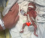 Cel mai prematur bebeluș din lume a împlinit 1 an. S-a născut la 21 de săptămâni, cântărea 280 gr și măsura 24 de cm. Cum arată acum