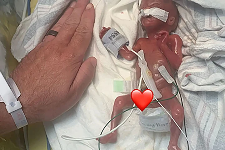 Cel mai prematur bebeluș din lume a împlinit 1 an. S-a născut la 21 de săptămâni, cântărea 280 gr și măsura 24 de cm. Cum arată acum